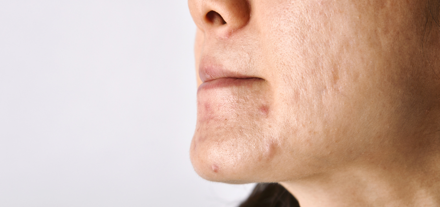 Hvorfor får jeg bumser og hvordan forhindres de?