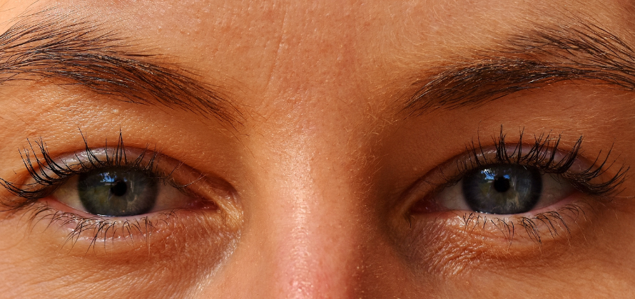 Når kontaktlinser giver tørre øjne