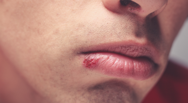 Forkølelsessår - Årsager, symptomer og behandling af forkølelsessår