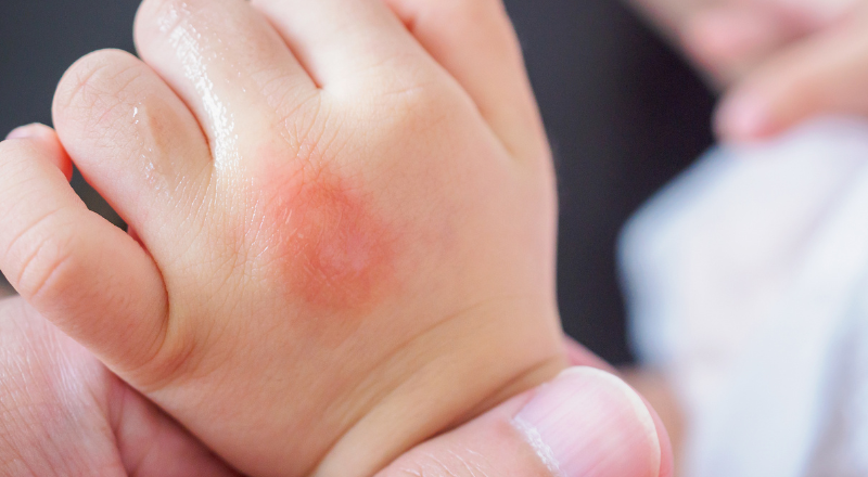 Gå til kamp mod børneeksemen